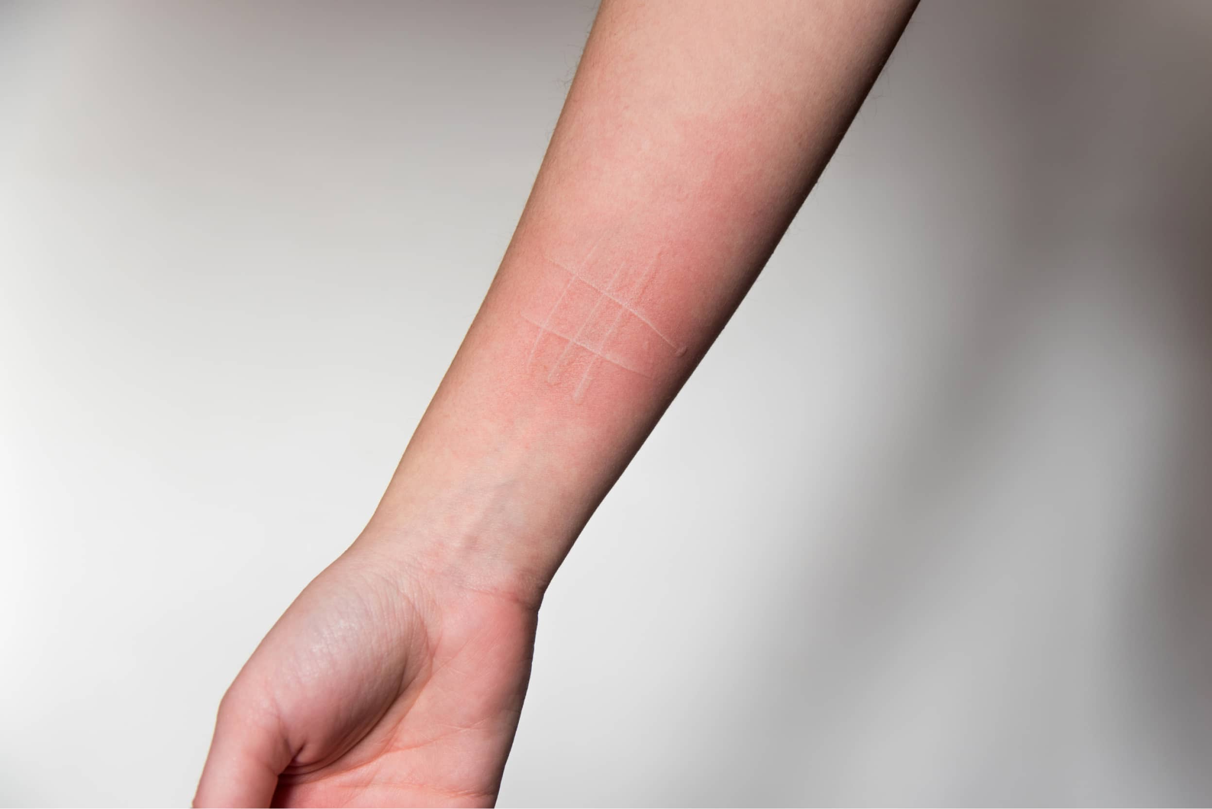 dermografismo causas y tratamiento in